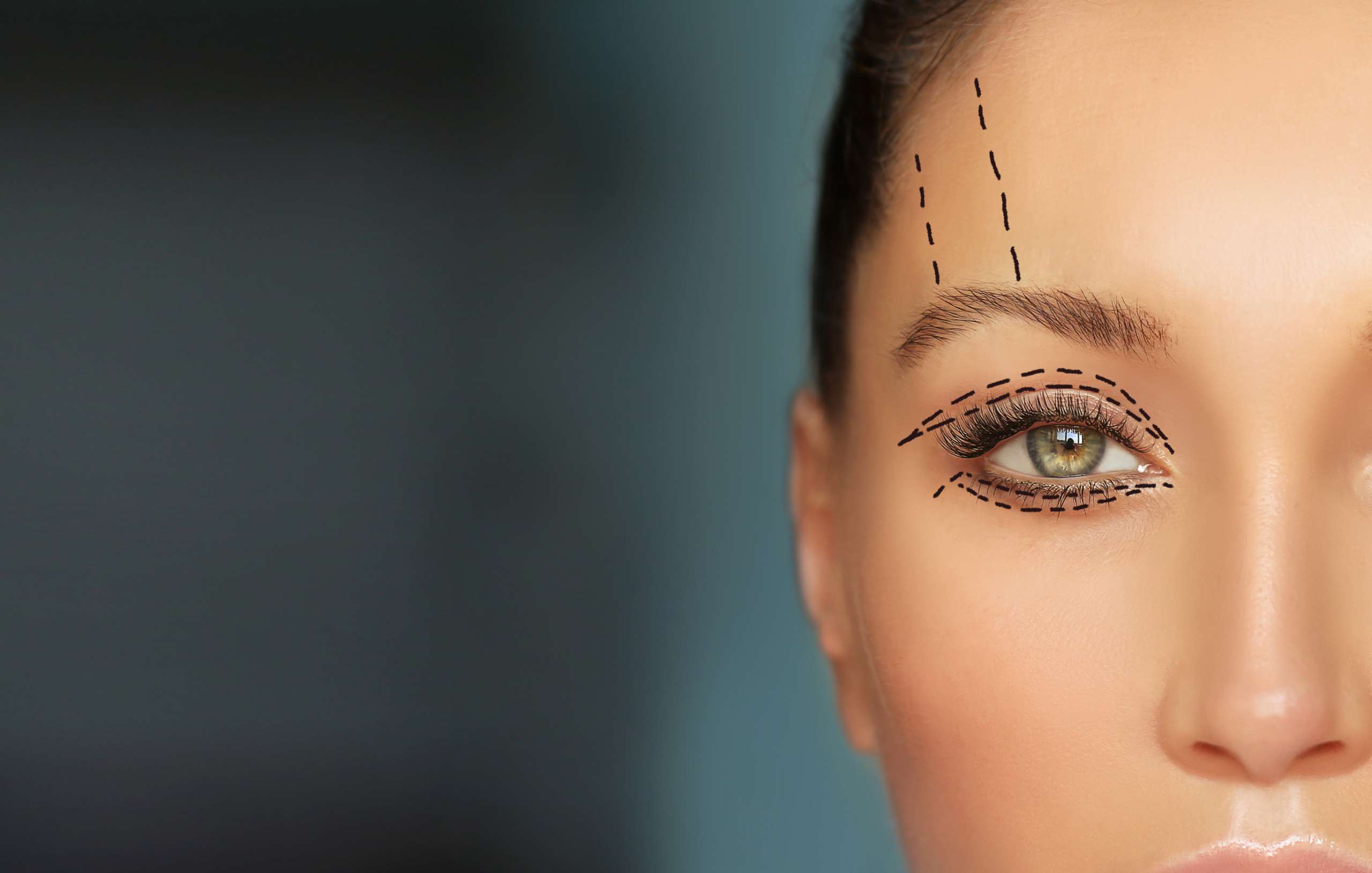 postoperatorio blefaroplastia en Cáceres