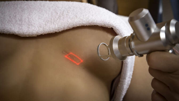 tratamiento de cicatrices con luz pulsada intensa