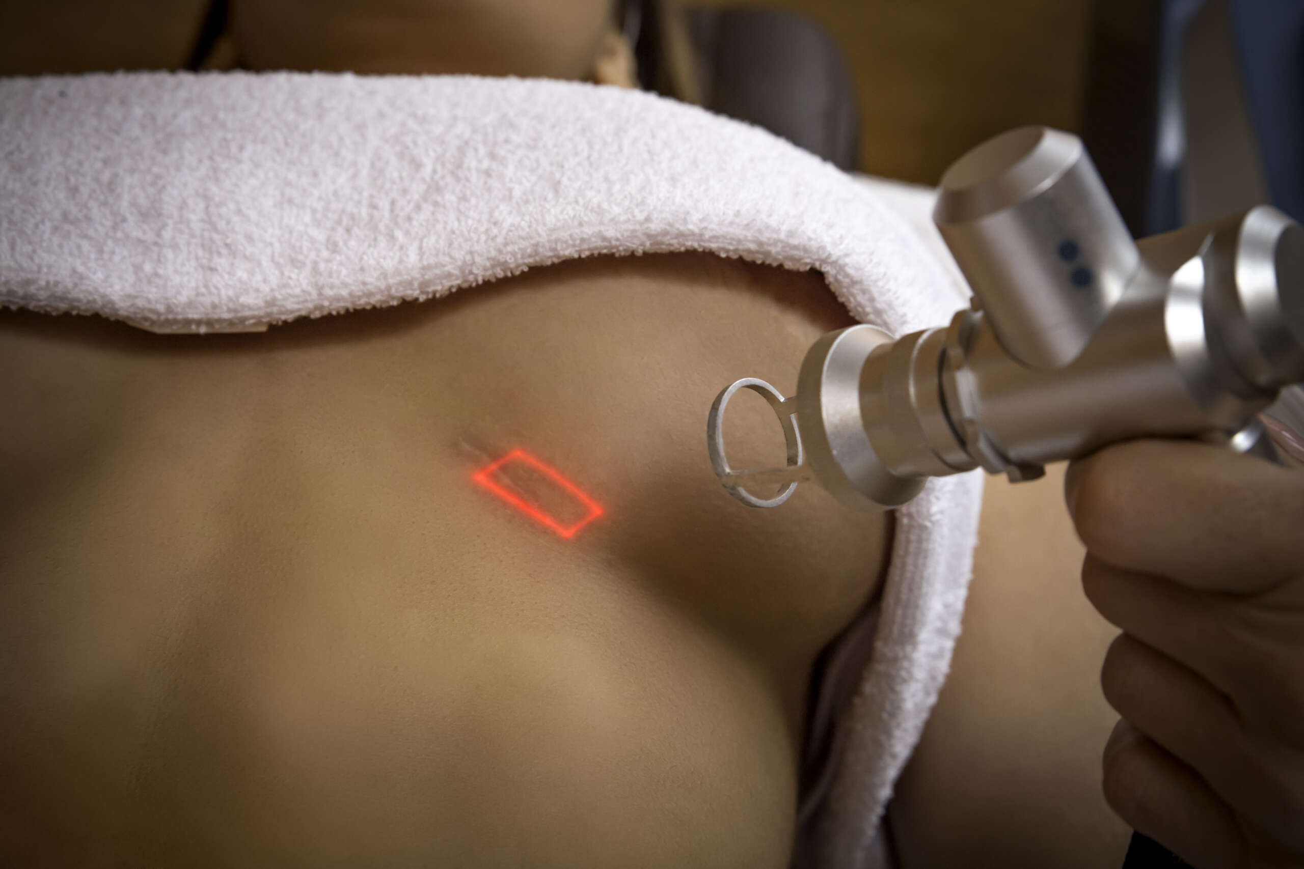 tratamiento de cicatrices con luz pulsada intensa