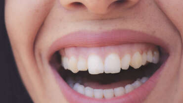 sonrisa gingival