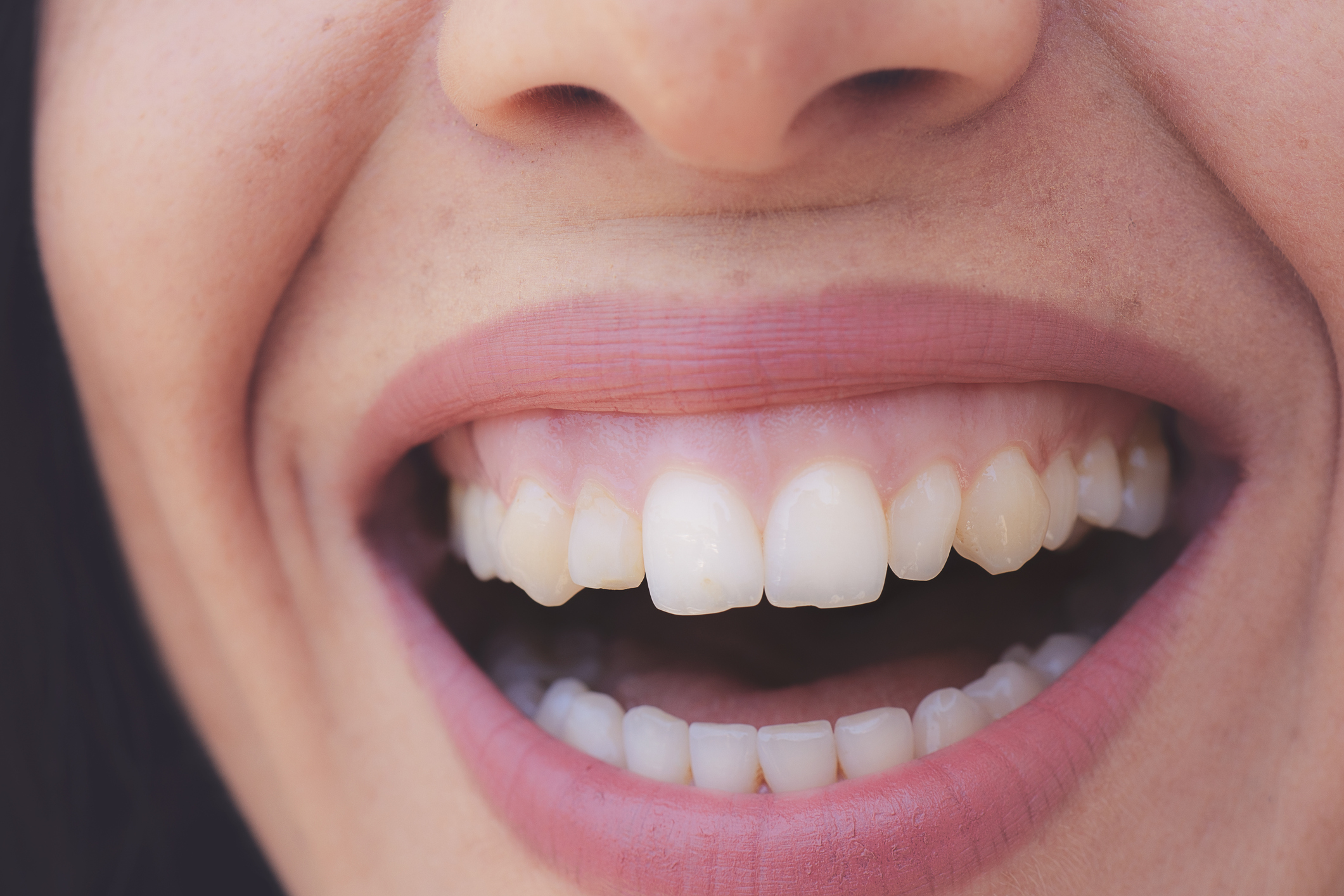 sonrisa gingival