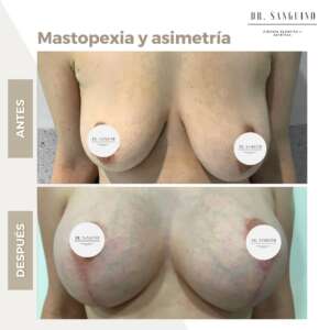 asimetría mamaria