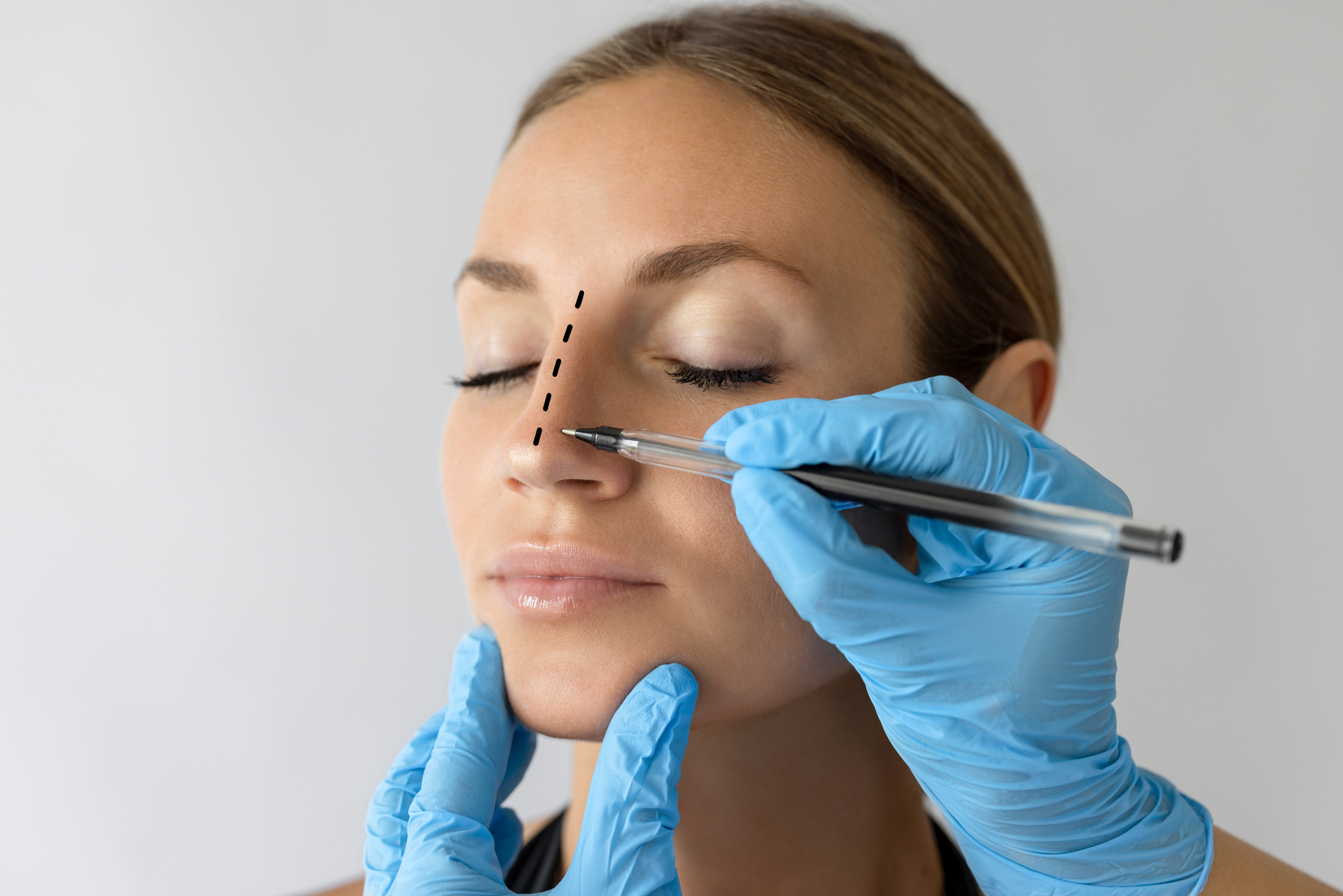 Rinoplastia y respiración